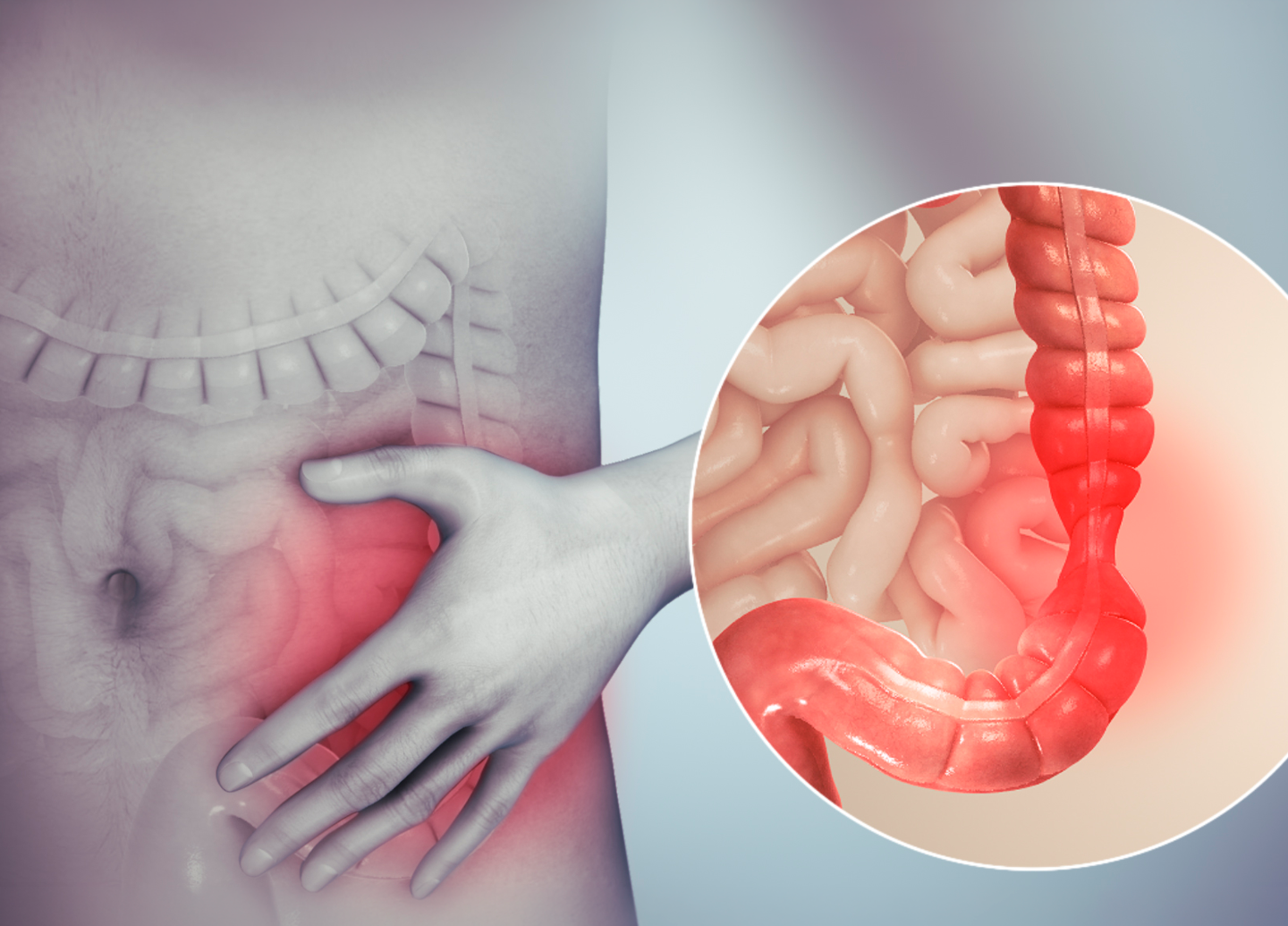 Ilustração de Intestino irritável